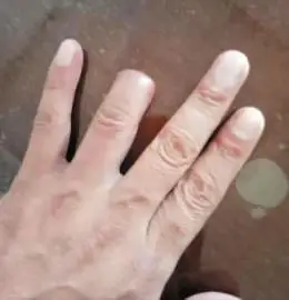 长春一市民打出租车遇意外无名指被夹断 两个月没有拿到任何赔偿