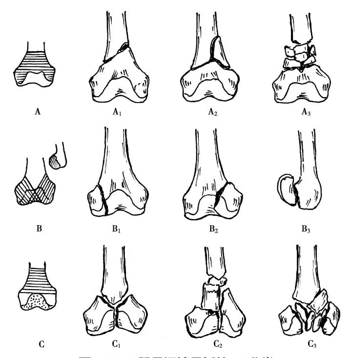 收藏 | 股骨远端骨折4种手术治疗方式