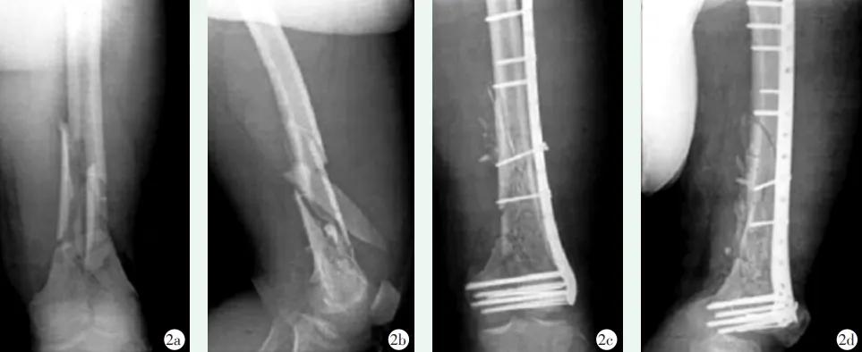 收藏 | 股骨远端骨折4种手术治疗方式