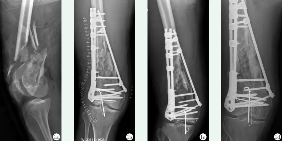 收藏 | 股骨远端骨折4种手术治疗方式