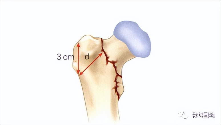 8个方面优化髓内钉治疗固定股骨粗隆间骨折