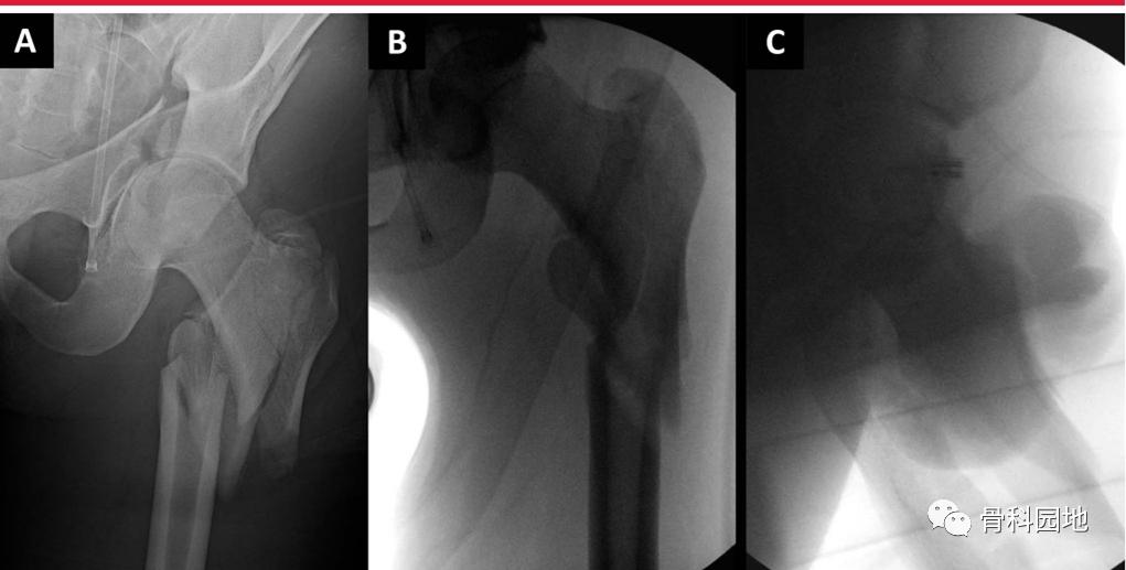 8个方面优化髓内钉治疗固定股骨粗隆间骨折