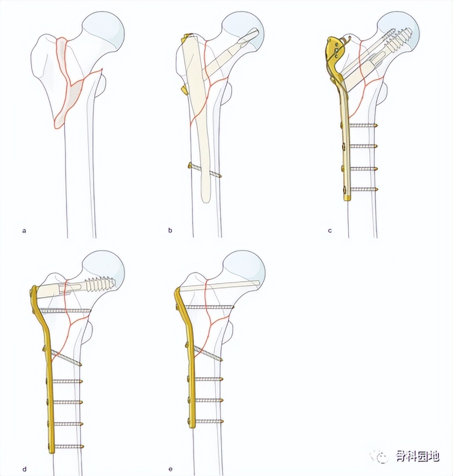 8个方面优化髓内钉治疗固定股骨粗隆间骨折