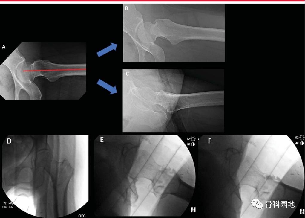 8个方面优化髓内钉治疗固定股骨粗隆间骨折