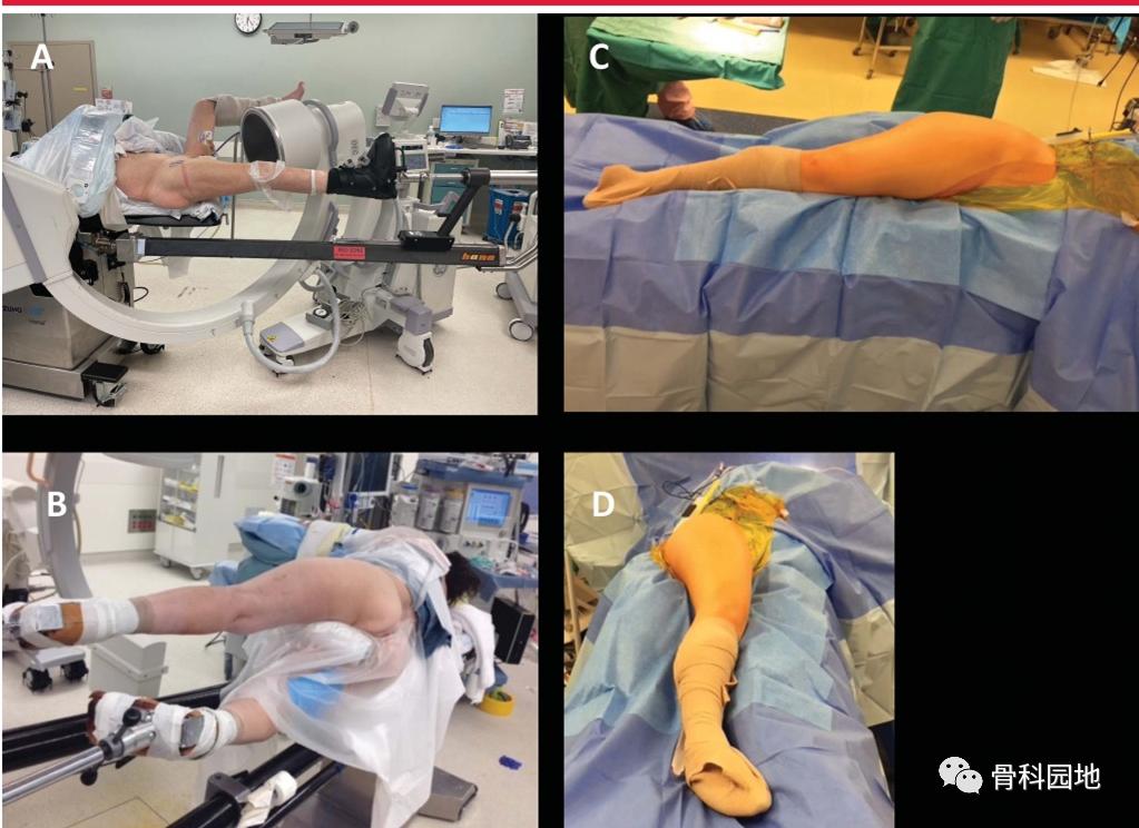 8个方面优化髓内钉治疗固定股骨粗隆间骨折