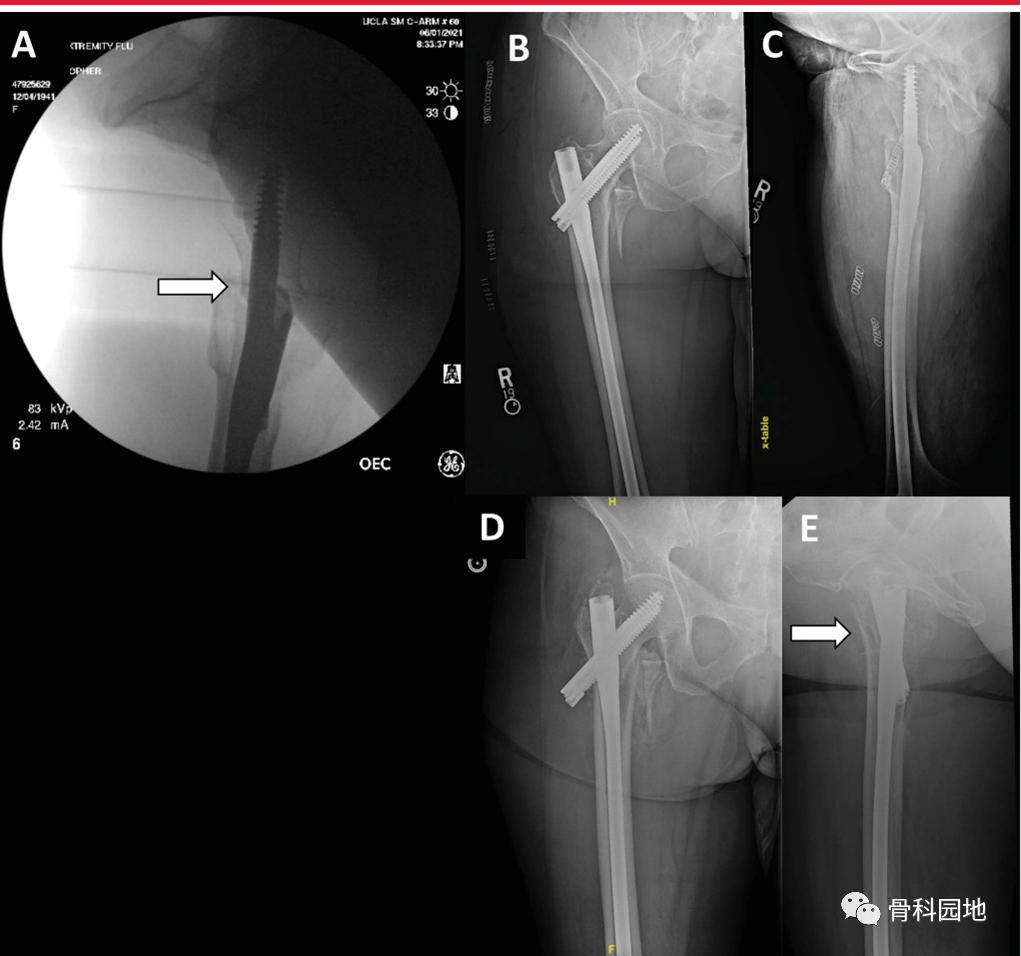 8个方面优化髓内钉治疗固定股骨粗隆间骨折
