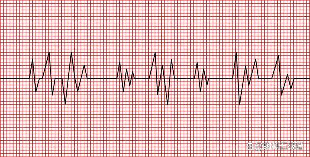 单凭心电图“ST-T段改变”诊断心肌缺血？你又错了……