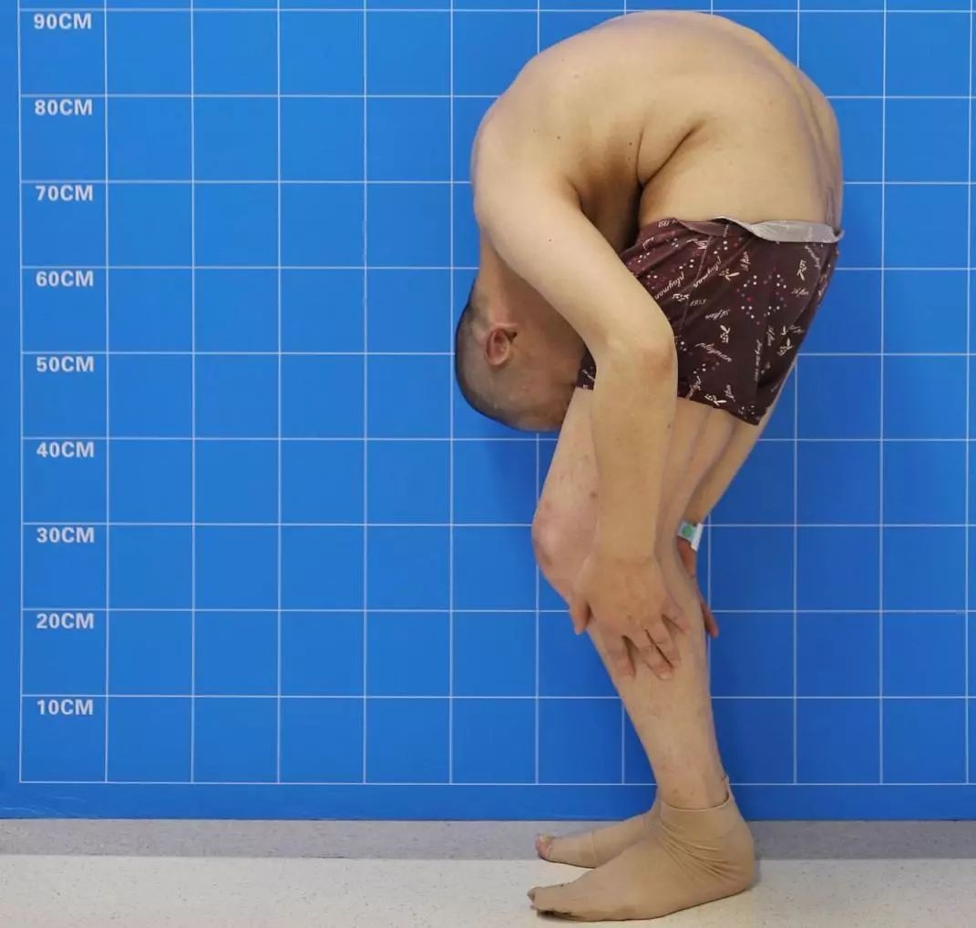 “折叠人”李华：骨头被敲断4次，植入22颗钢钉，如今重获新生