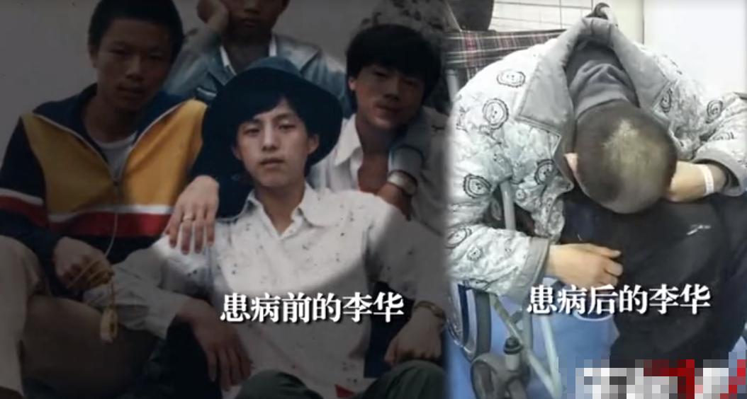 “折叠人”李华：骨头被敲断4次，植入22颗钢钉，如今重获新生