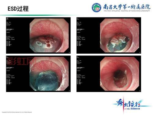 [深入了解ESD手术：内镜下黏膜剥离术的优势与应用]