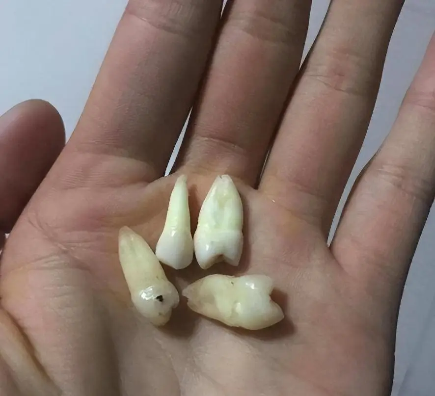 河北男子拿不出100万手术费，回家自己锯掉右腿，13年过去怎样了