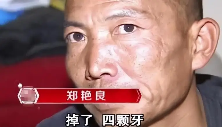 河北男子拿不出100万手术费，回家自己锯掉右腿，12年过去怎样了