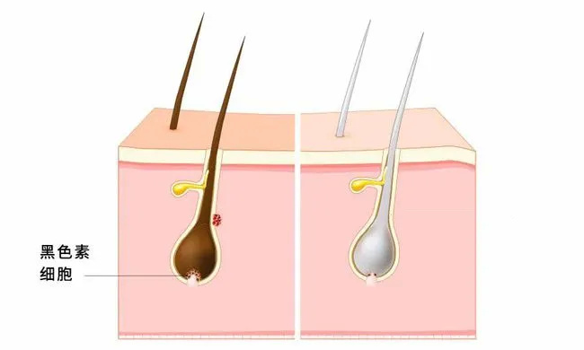 “白头发”可能预示这些疾病！5个因素导致长白发