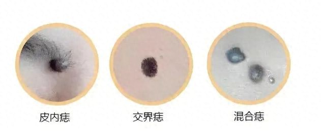 危险的痣长啥样？记住这个“ABCDE法则”