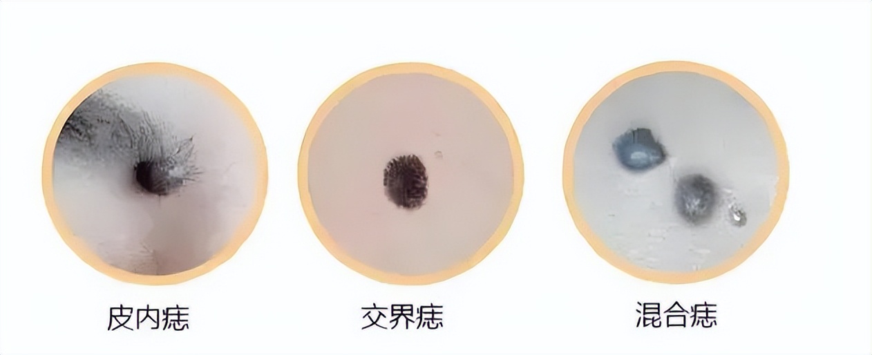 危险的痣长啥样？记住这个“ABCDE法则”！