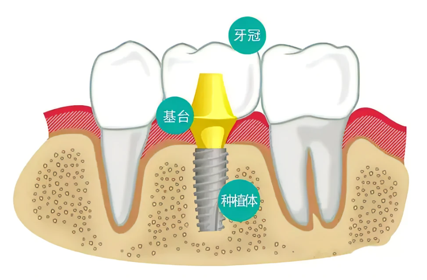 想种牙看这一篇就够了，种植牙全攻略！——种植牙怎么选？怎么种？多少钱？