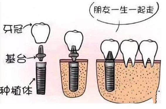想种牙看这一篇就够了，种植牙全攻略！——种植牙怎么选？怎么种？多少钱？