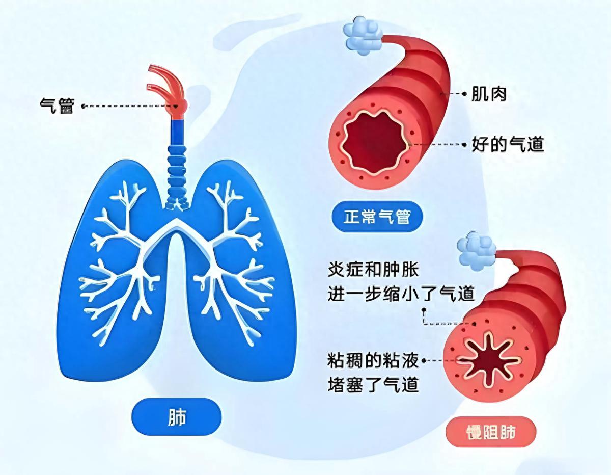 成都中医哮喘医院姚宏胤医生解析:慢阻肺什么时候治疗最好?