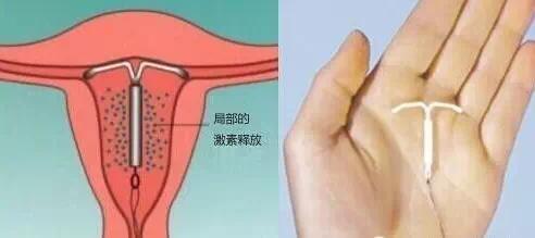 你老婆上环了吗？请善待她的身体，看了想骂人！